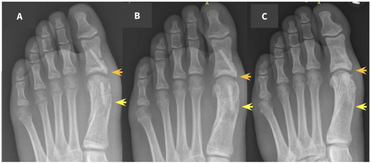 Innovación en ortopedia pediátrica: osteosíntesis con tornillos de aloinjerto